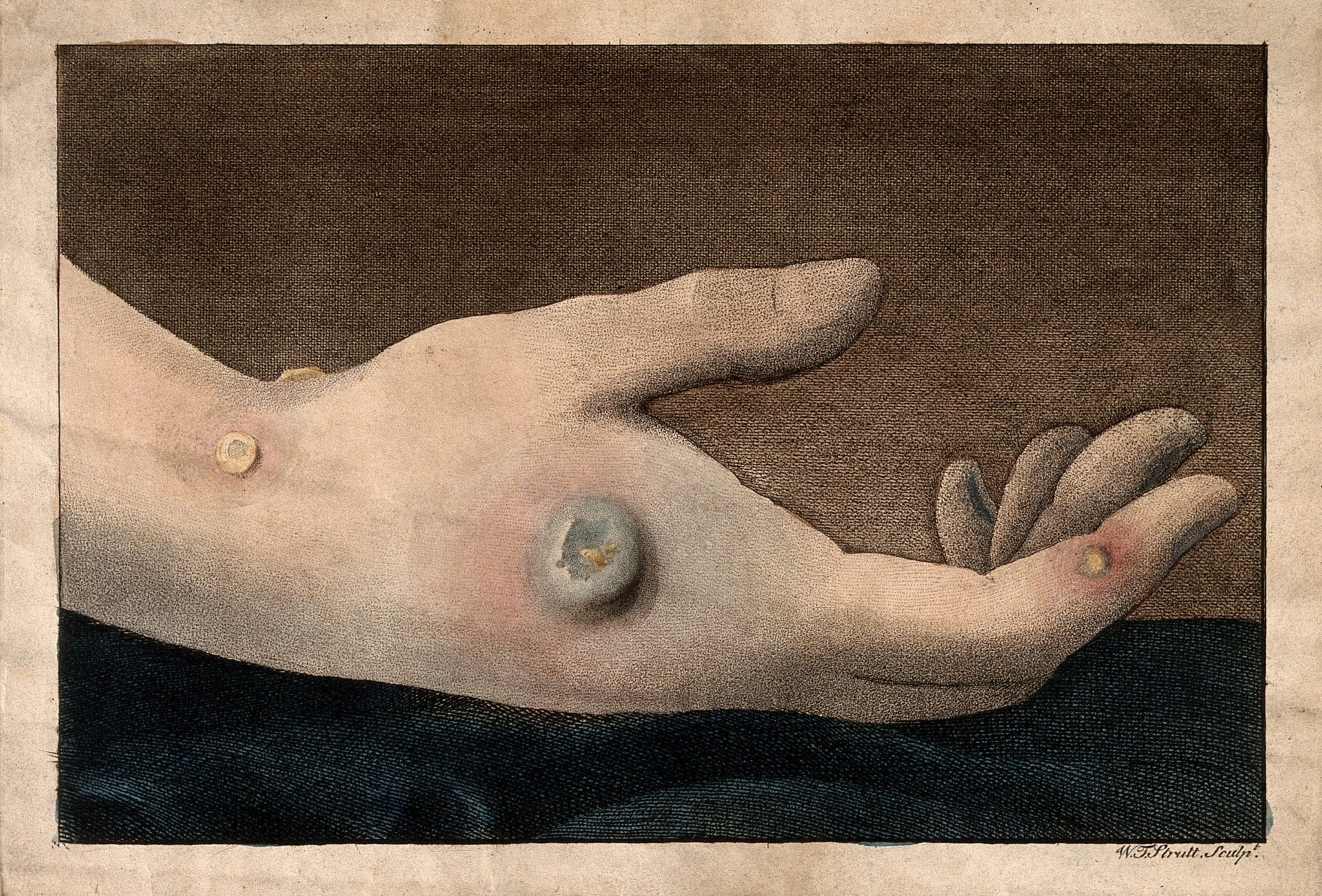 Hand with smallpox pustules, which would have been used for variolation