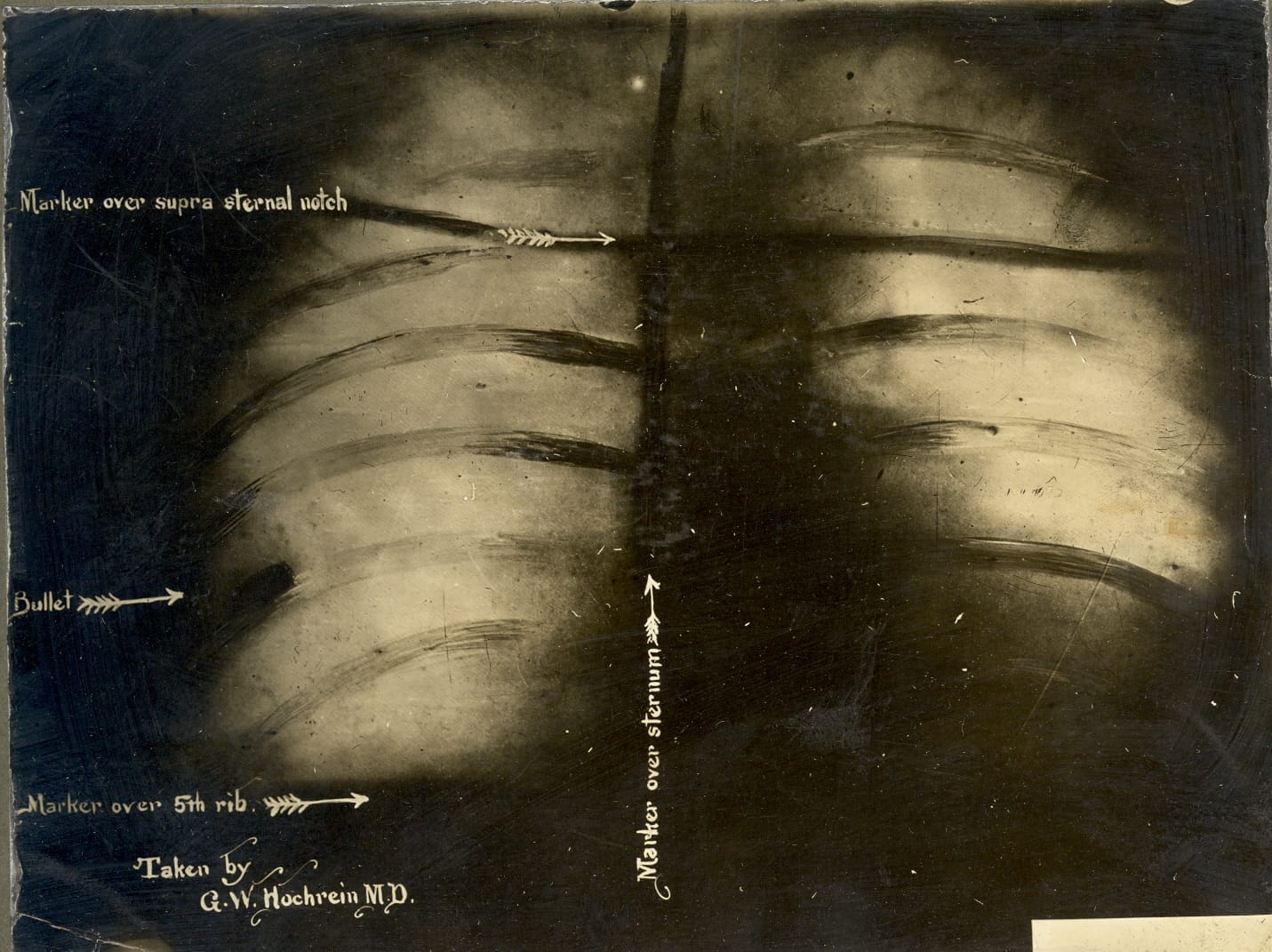 Teddy Roosevelt’s Chest X-ray with bullet overlying rib