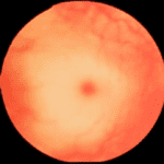 Cherry red spot at macula in Tay-Sachs disease, subject of a medical metaphor
