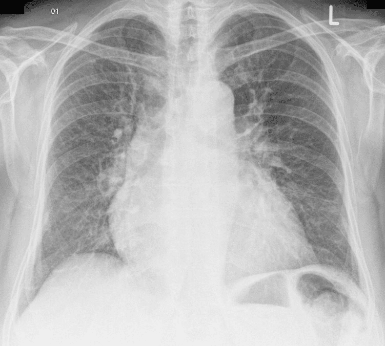 X-ray of pulmonary congestion in heart failure