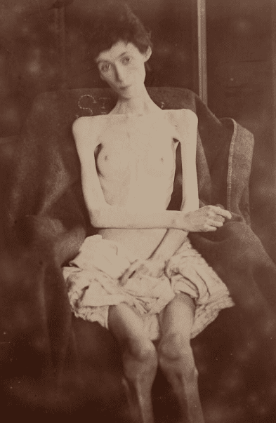 Woman suffering from anorexia nervosa, an idiom of distress