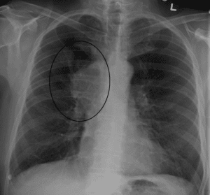 Person with lung cancer