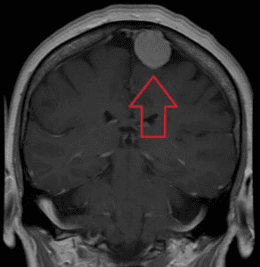 MRI of brain tumor