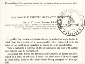 Text of AW Mayo-Robson's commentary on meningocele stating that exicison of a meningocele is generally not "so heroic as to be unjustifiable"