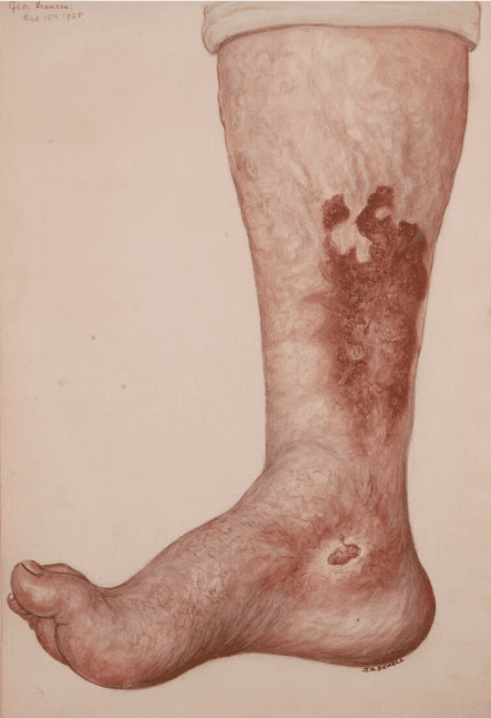 Leg with ulcers