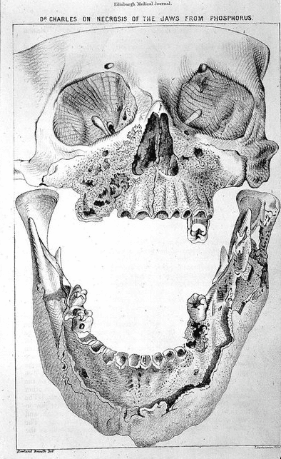 Extremely porous skull with only four teeth remaining