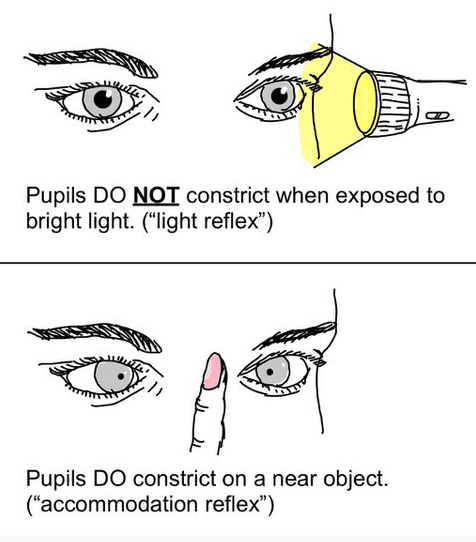Two diagrams of eyes displaying symptoms of neurosyphilis via Argyll Robertson pupils: the top pair is with a flashlight and shows and reads that "Pupils DO NOT constrict when exposed to bright light. ("light reflex")"; the bottom shows a finger held up between the eyes and reads "Pupils DO constrict on a near object".