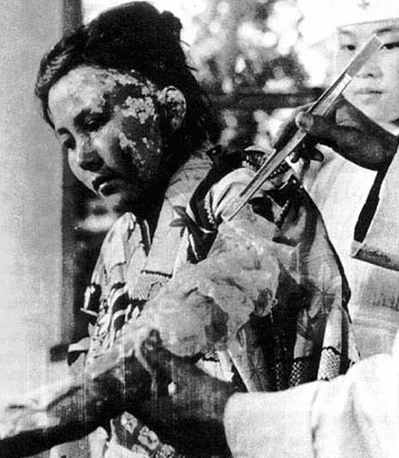 Woman being treated for severe radiation burns from the atomic bomb