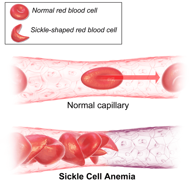 Diagram showing normal red blood cells able to move through capillary without restriction, while sickle or curved red blood cells get stuck in the capillary and can't move forward